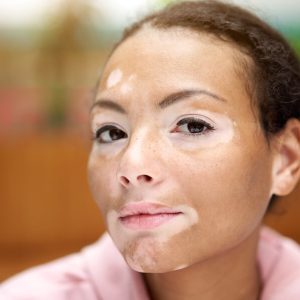 vitiligo2